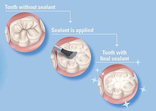 Dental Sealants: What are they, are they safe, and do they work? 8